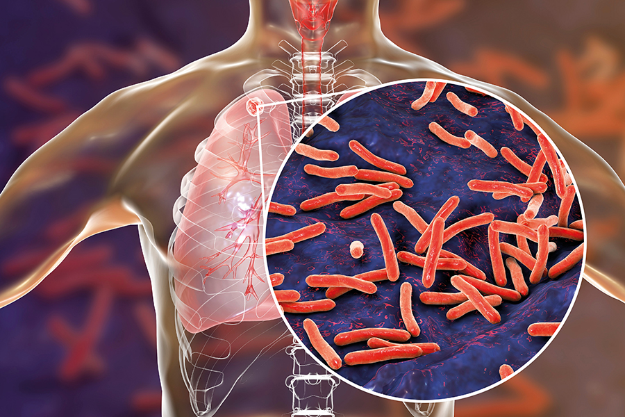 WHO and the Stop TB Partnership publish a TB near point-of-care and swab-based testing toolkit