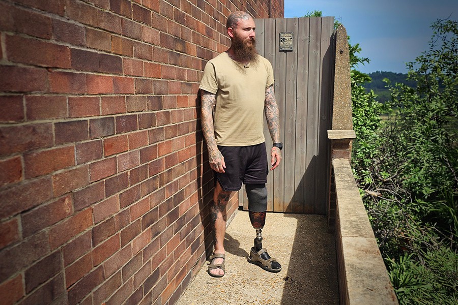 Majority of UK amputees feel unprepared and unheard in their first prosthetic limb decisions, new research finds